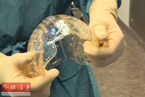 外媒：首例3D打印头盖骨移植手术成功（图）